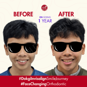 Klinik Gigi BSD DOKGI Invisalign