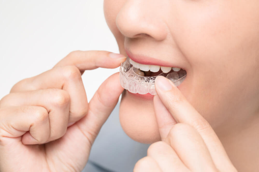 cara kerja invisalign