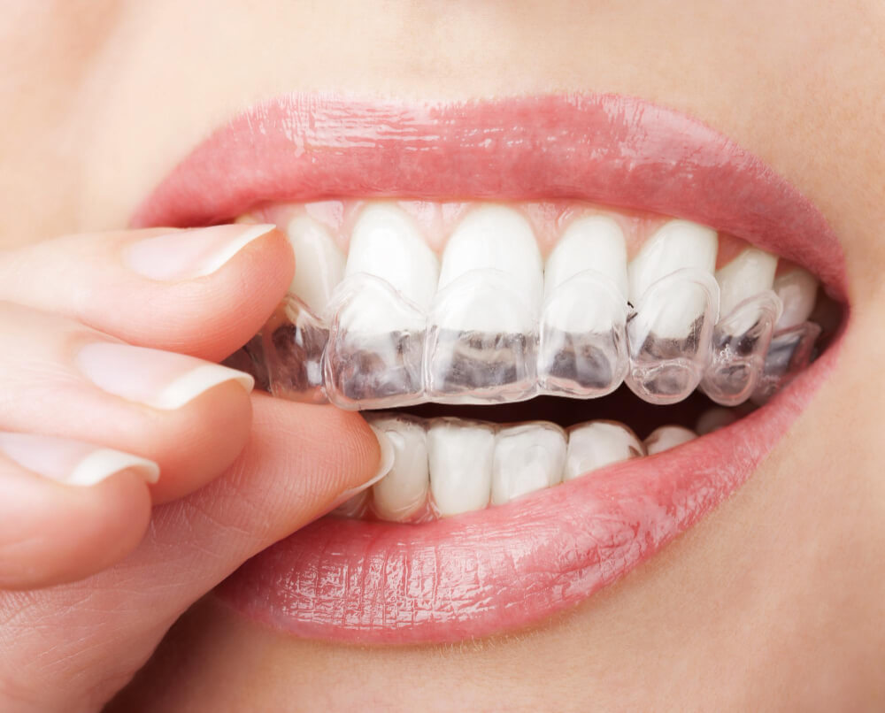 invisalign untuk gigi gingsul