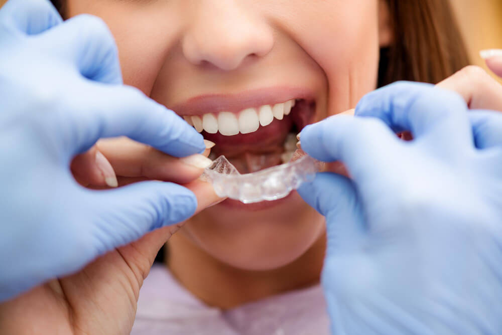 invisalign untuk gigi tonggos