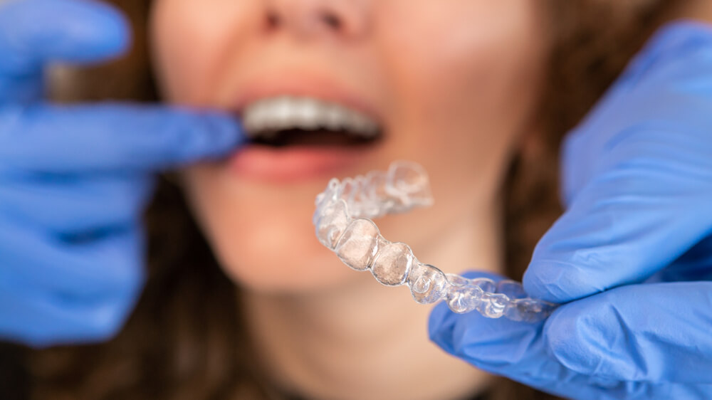 invisalign-untuk-gigi-berjejal