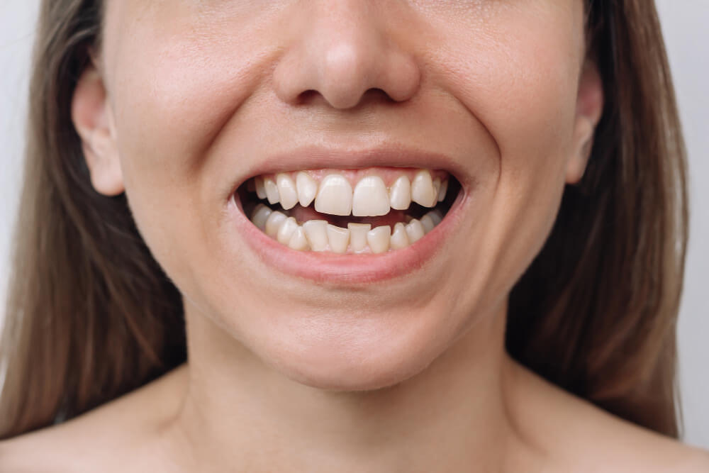 aligner-gigi-untuk-gigi-berantakan